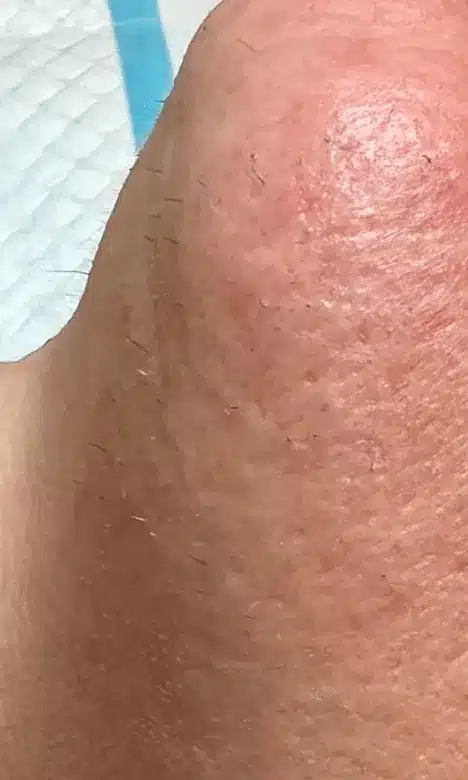 Poils sur le menton avant l'épilation par électrolyse chez My Laser