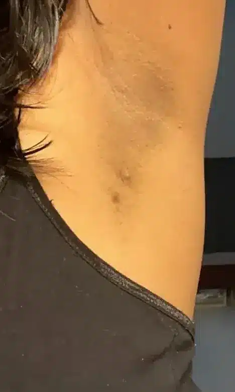 Aisselle lisse sur peau mate après l'épilation laser chez My Laser