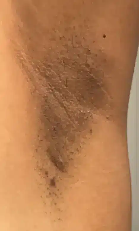 Aisselle avec poils sur peau mate avant l'épilation laser chez My Laser