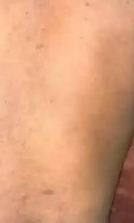 Dos d'homme lisse après les séances d'épilation laser chez My Laser