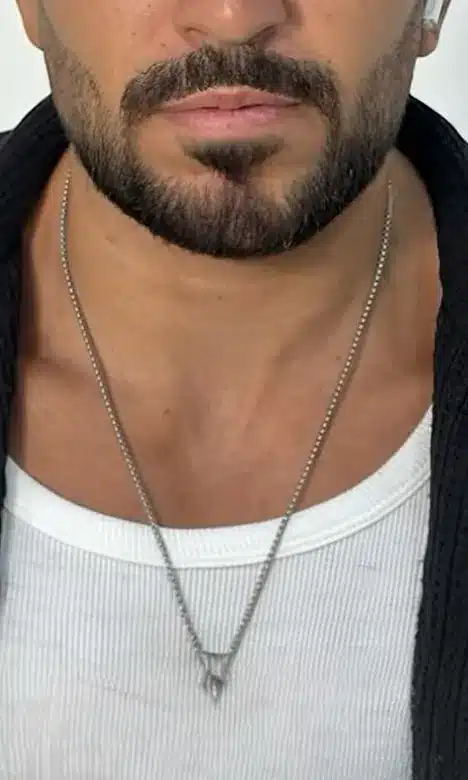 Mâchoire d'homme avant l'injection d'acide hyaluronique de la jawline chez My Laser