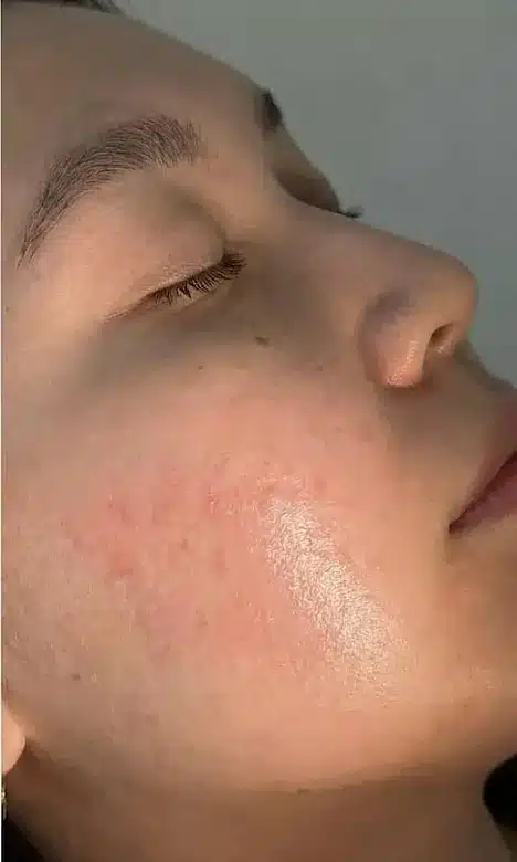 Joue au grain de peau lissé après les séances de Laser Frax chez My Laser