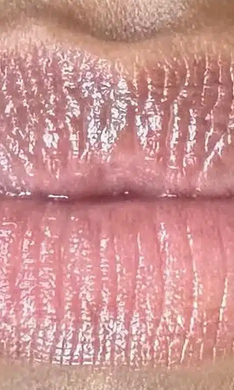 Lèvres plus claires et rosées après le Lips bleaching chez My Laser
