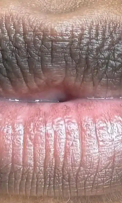 Lèvres foncées avant le protocole Lips bleaching chez My Laser