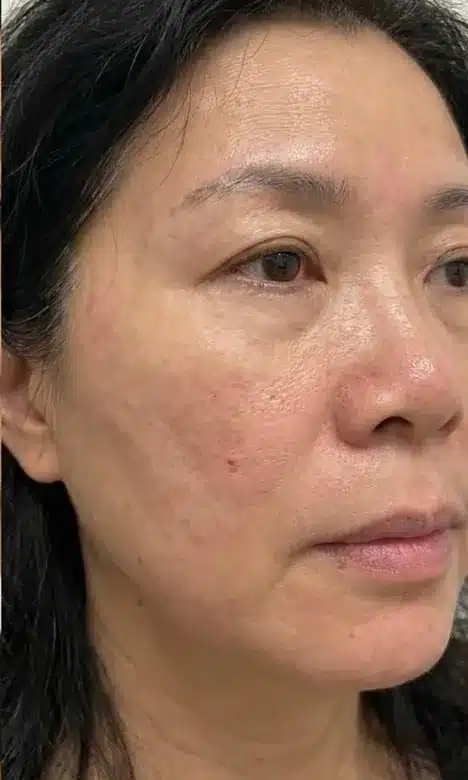 Teint unifié après le protocole Dermamelan contre le mélasma chez My Laser