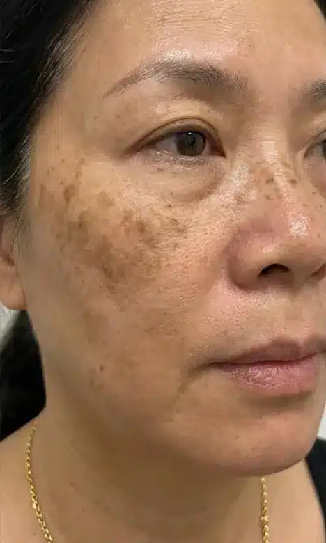 Taches de mélasma sur la joue avant le protocole Dermamelan chez My Laser