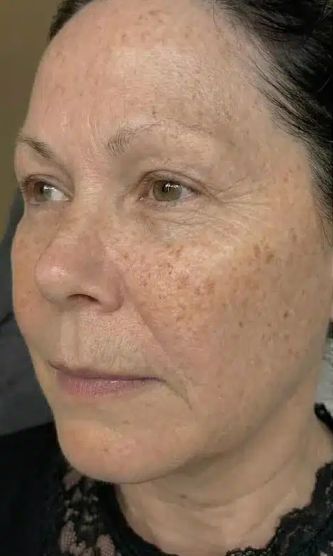 Taches pigmentaires sur le visage avant le protocole Neoskin chez My Laser