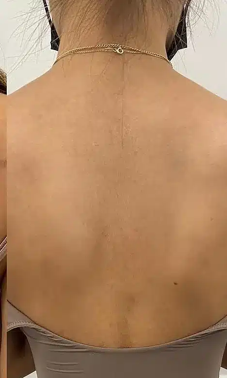 Dos à la peau nette après le peeling du dos chez My Laser