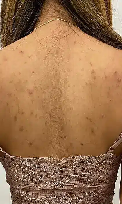 Dos marqué par l'acné et les taches avant le peeling du dos chez My Laser