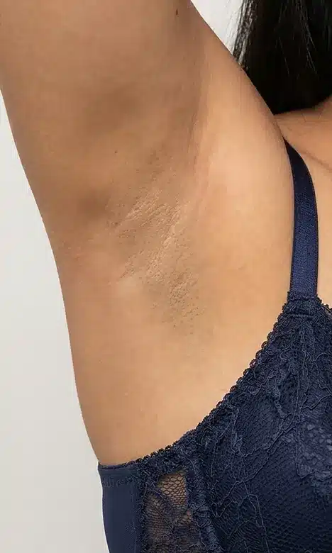 Aisselle éclaircie après le peeling intime chez My Laser