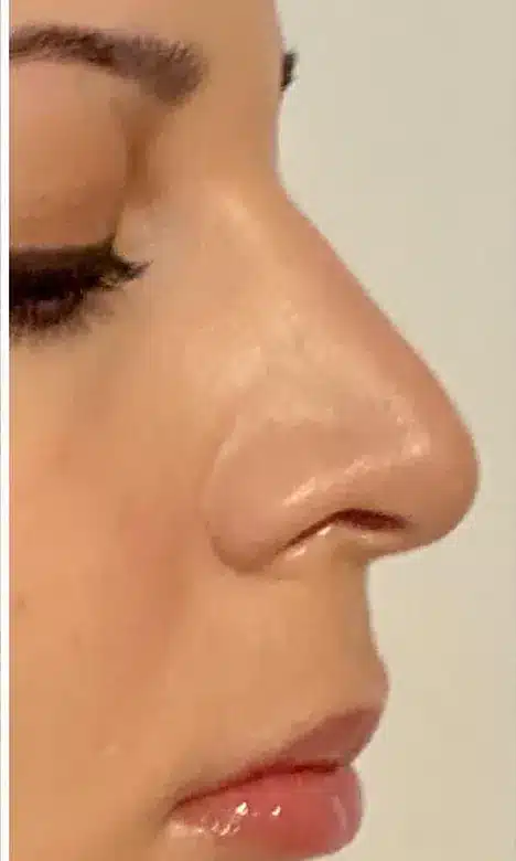 Profil du nez redessiné après la rhinoplastie médicale à l'acide hyaluronique chez My Laser