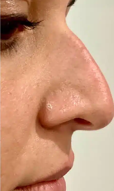 Profil du nez avec une bosse avant la rhinoplastie médicale chez My Laser