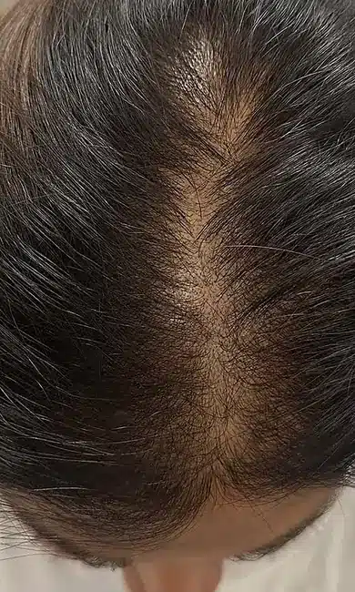 Cheveux plus denses le long de la raie après le traitement capillaire chez My Laser