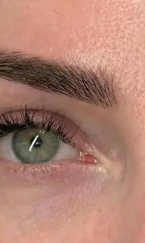 Contour de l'œil éclairci après le traitement péri-oculaire chez My Laser