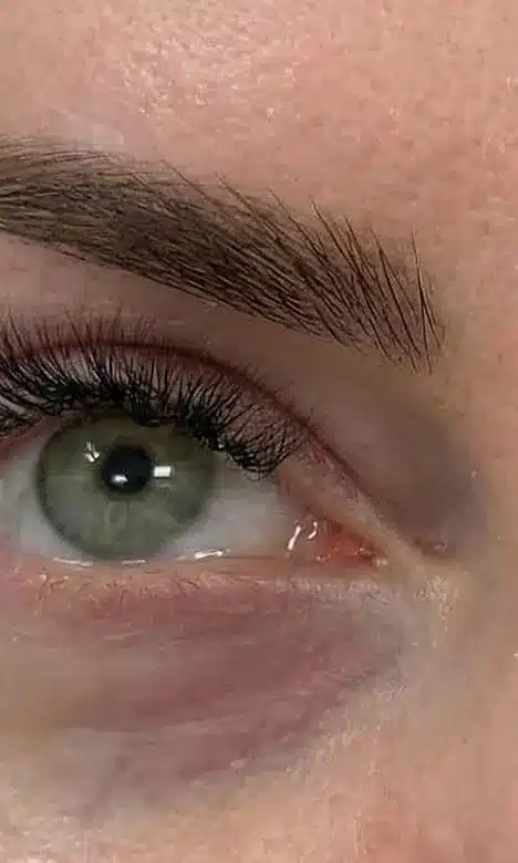 Cernes marqués sous l'œil avant le traitement péri-oculaire chez My Laser