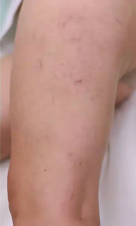 Jambe aux varicosités atténuées après le traitement laser chez My Laser
