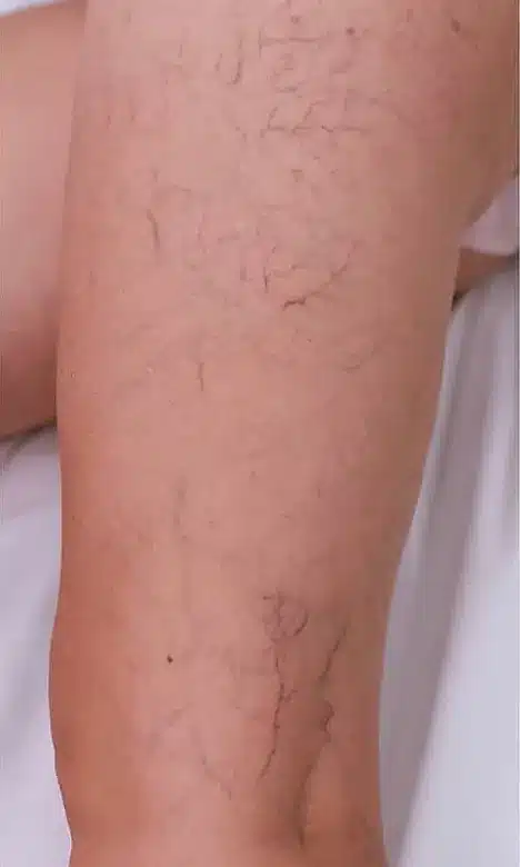 Varicosités sur la jambe avant le traitement laser chez My Laser