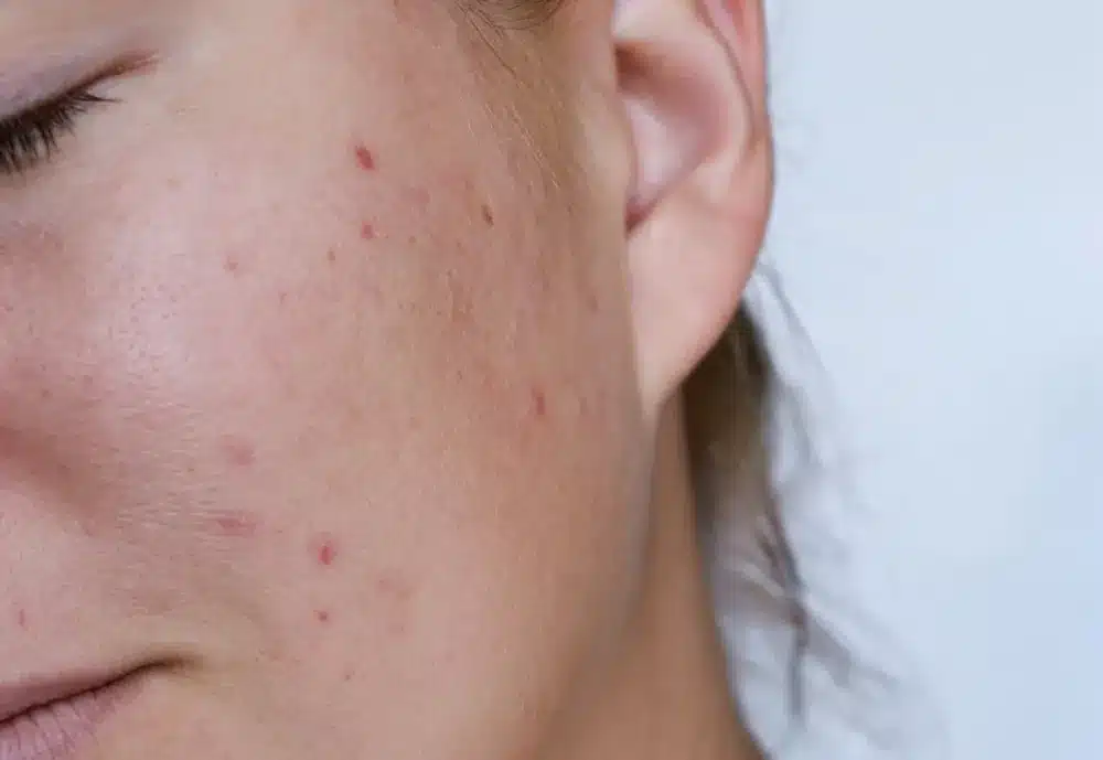 Traitement de l'acné par le protocole Blemiderm chez My Laser Bordeaux