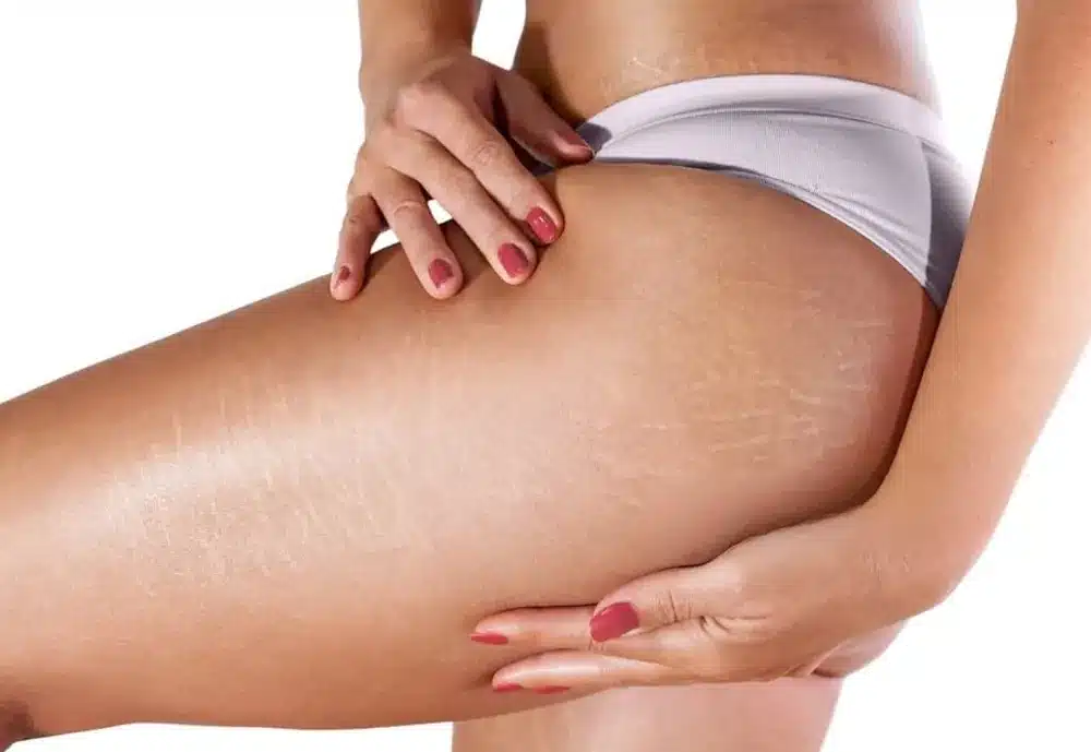 Cryolipolyse pour remodeler la silhouette chez My Laser Lyon