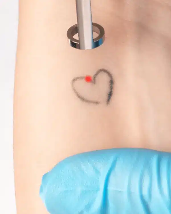 Séance de détatouage au laser sur un petit tatouage