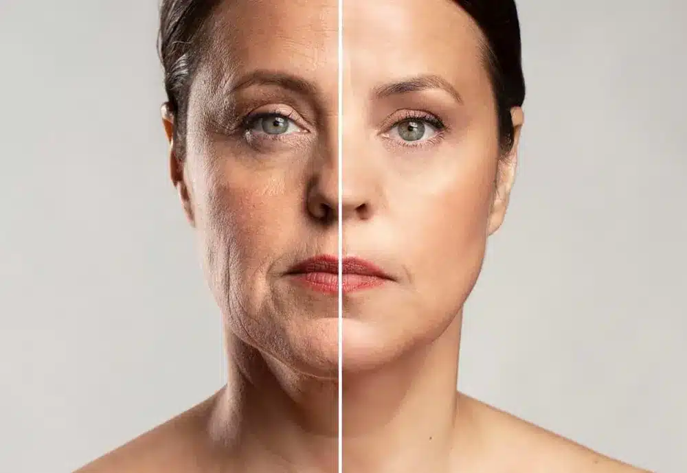 Raffermissement du visage par Endolift chez My Laser Bordeaux