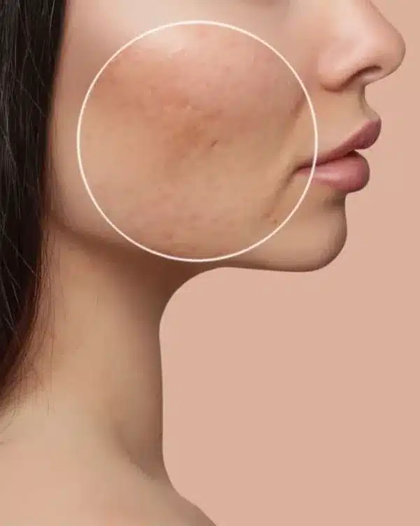 Traitement des cicatrices d'acné au Laser Frax