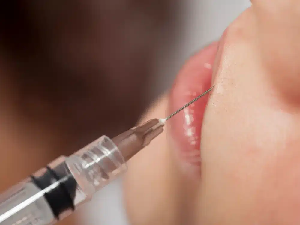 Injection d'acide hyaluronique des lèvres chez My Laser Bordeaux