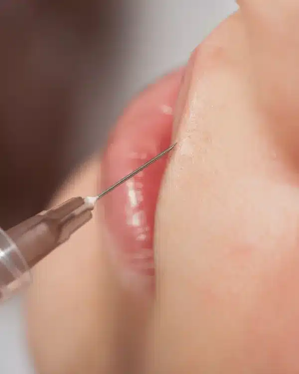 Injection d'acide hyaluronique des lèvres chez My Laser