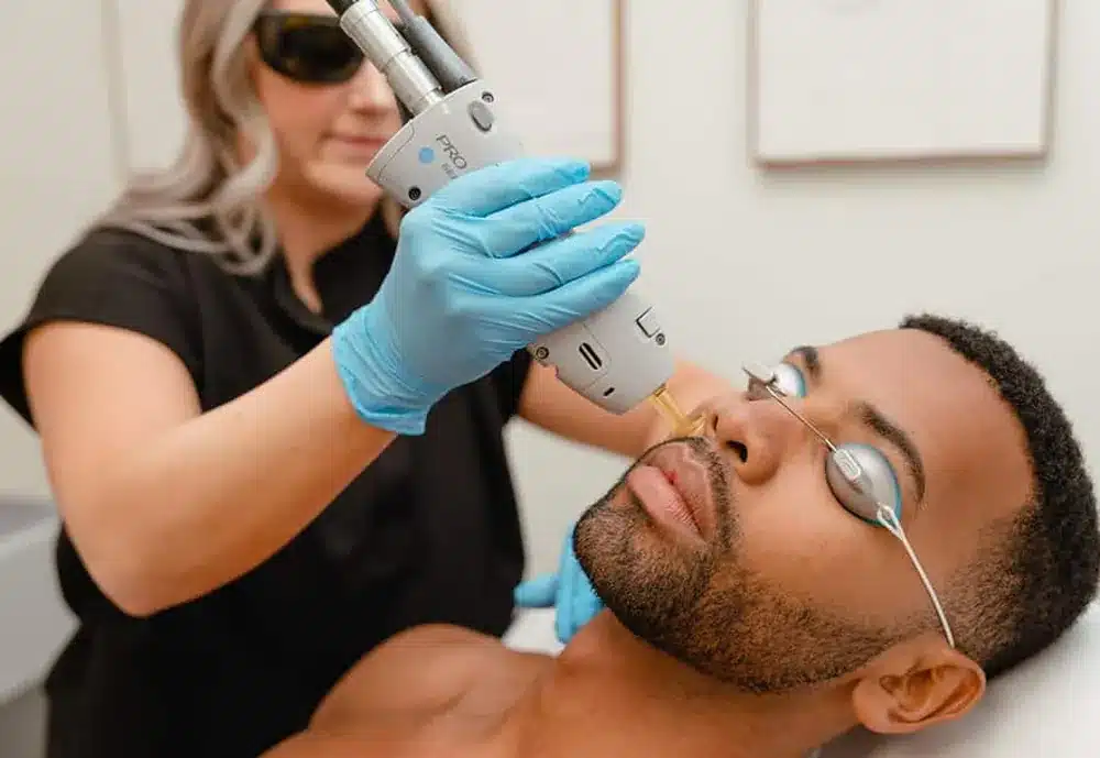 Épilation laser du visage d'un homme chez My Laser Bordeaux