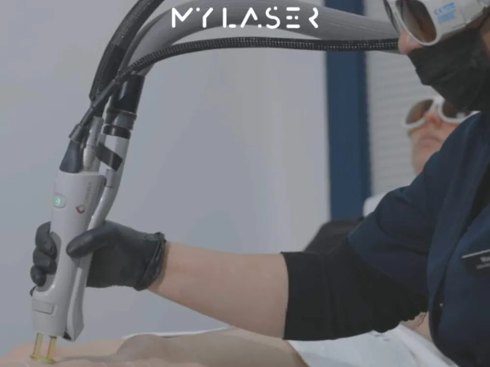 Séance d'épilation laser dans le centre My Laser Bordeaux