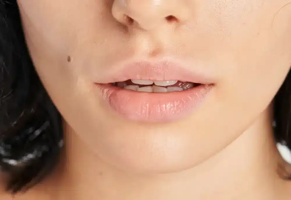Lips bleaching, éclaircissement des lèvres, chez My Laser Bordeaux