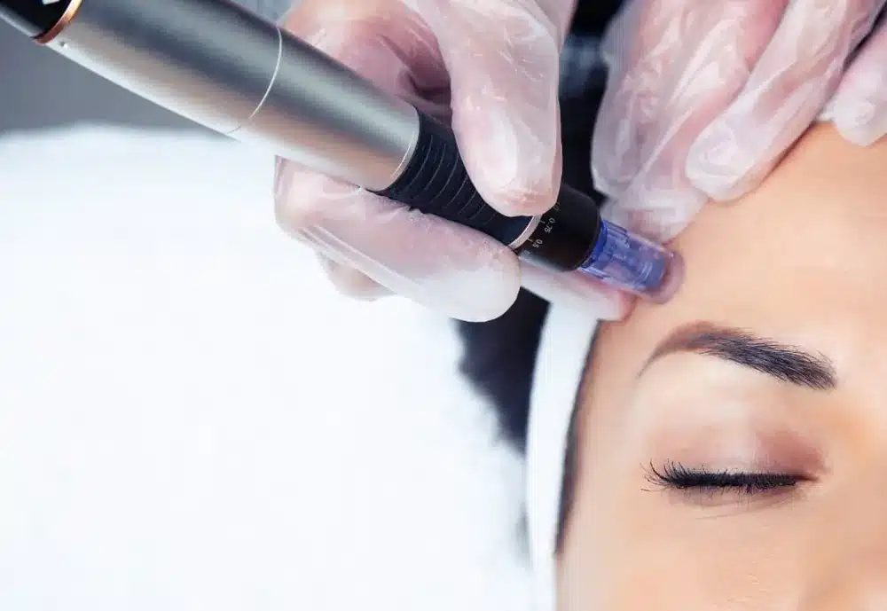Séance de mésothérapie du visage chez My Laser Bordeaux