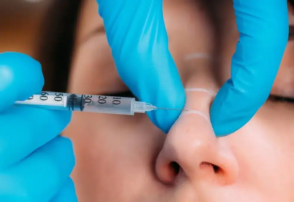 Rhinoplastie médicale par injection d'acide hyaluronique chez My Laser Bordeaux