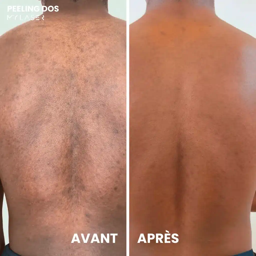 Dos à la peau foncée couvert de petites taches sombres avant, peau plus uniforme après un peeling dos