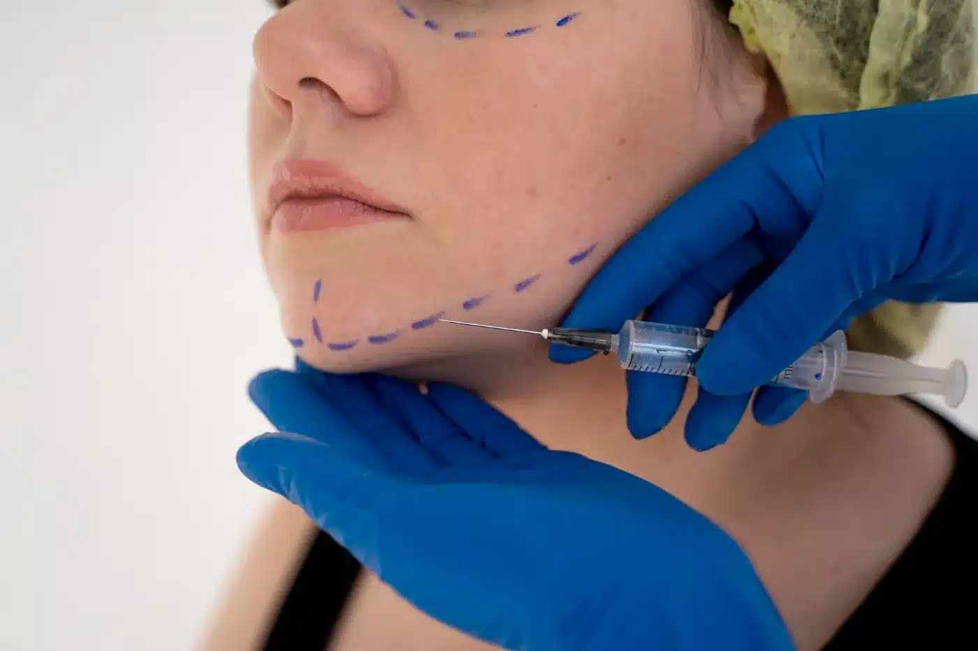 Injection le long de la mâchoire, zones tracées au crayon bleu sur le visage, mains gantées