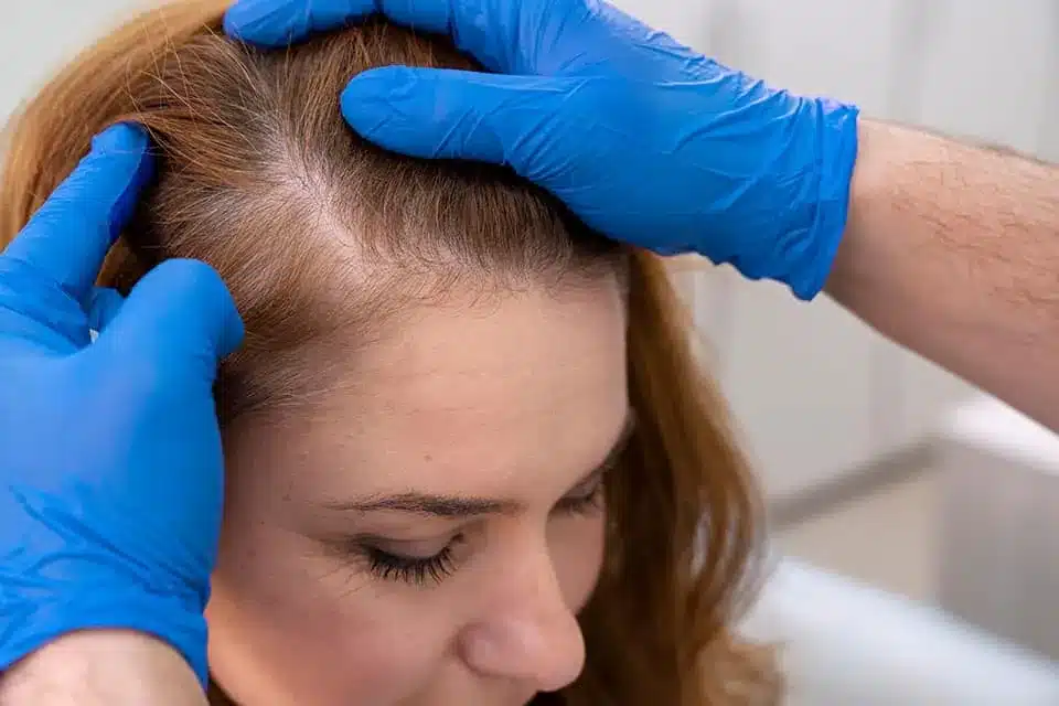 Mains gantées qui écartent les cheveux d'une femme pour examiner une raie clairsemée