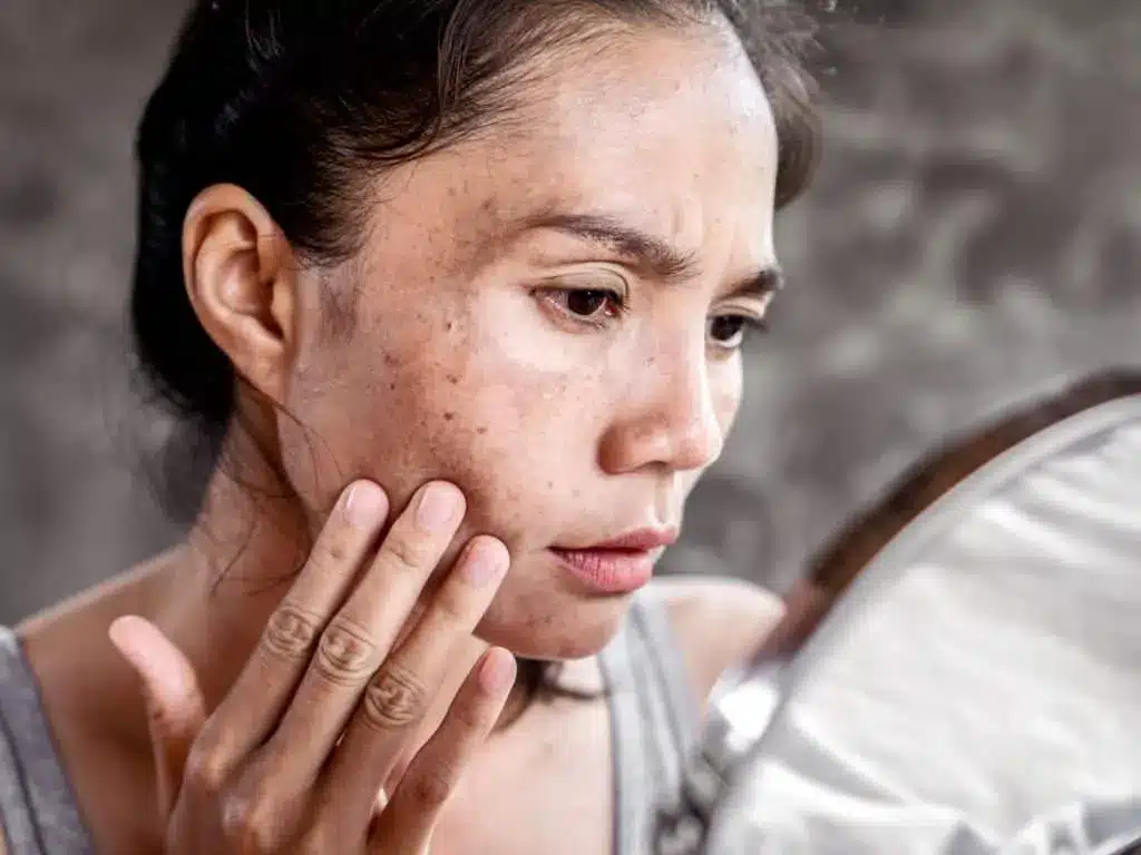 Femme observant dans un miroir les taches pigmentaires de sa joue