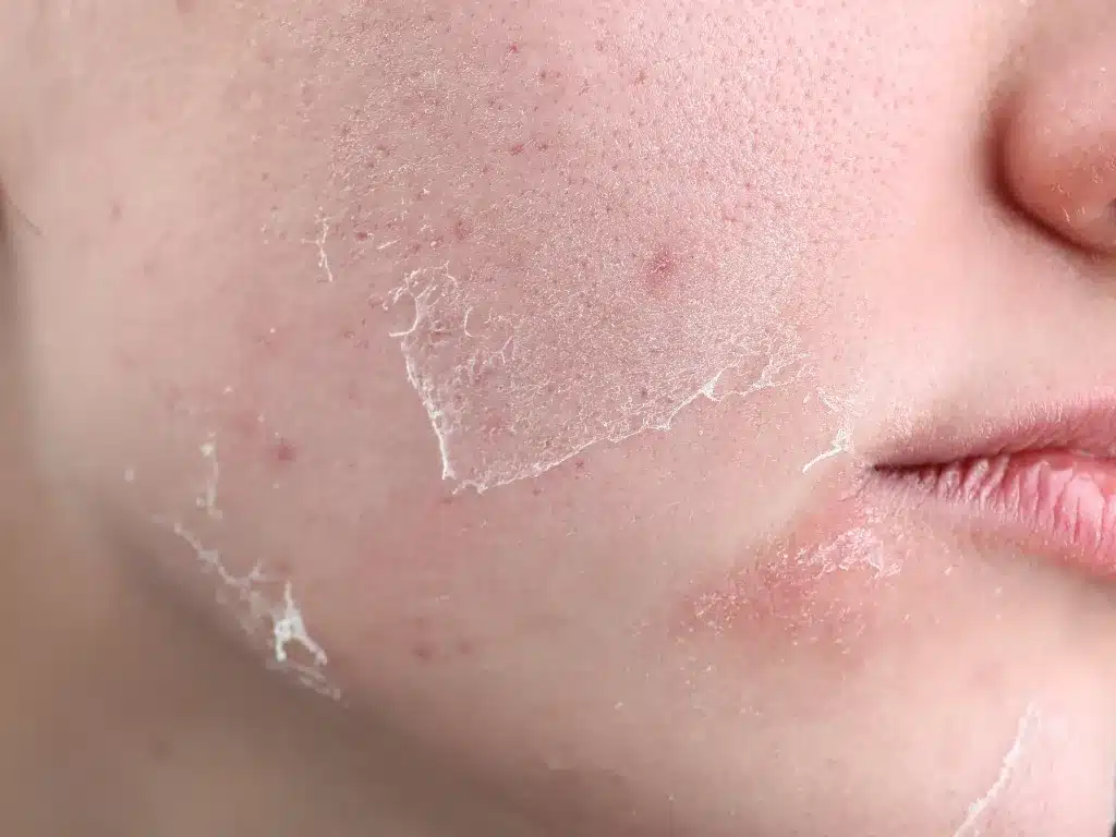 Joue qui pèle légèrement après un peeling, avec quelques rougeurs