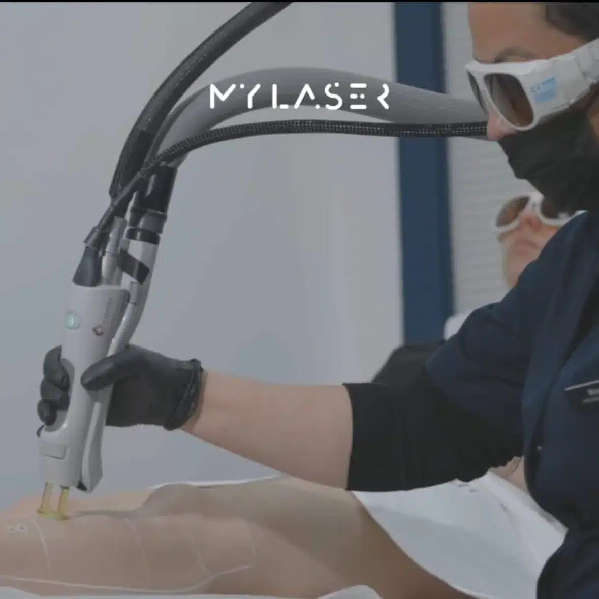 Séance d'épilation laser chez My Laser : pièce à main Candela sur la jambe