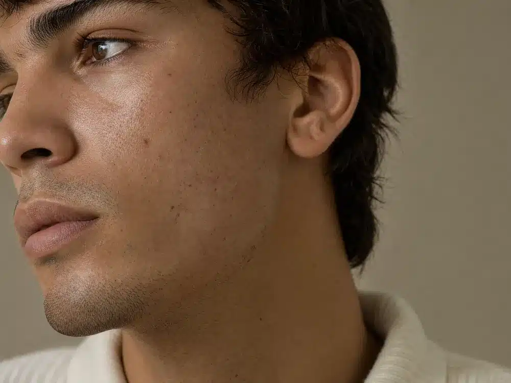 Joue d'un jeune homme présentant quelques imperfections d'acné
