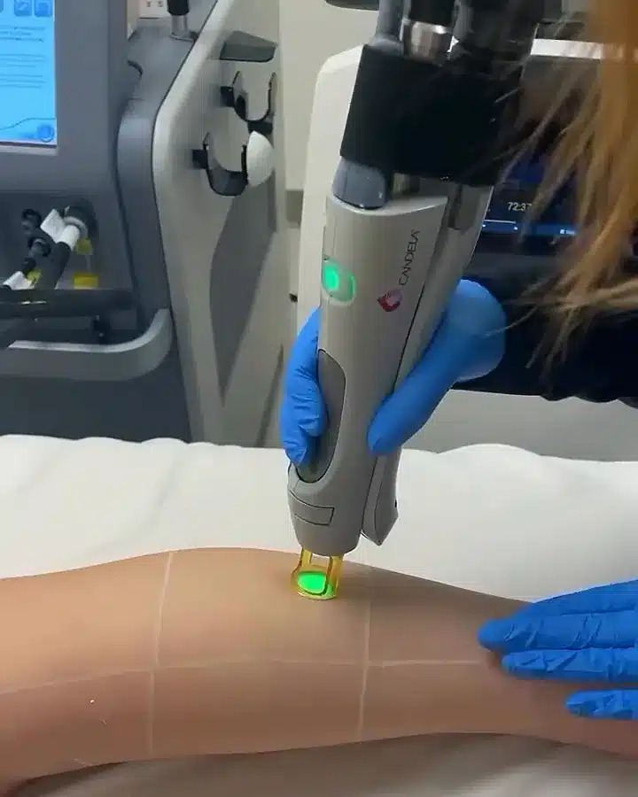 Pièce à main Candela d'un laser médical d'épilation posée sur une zone quadrillée, écrans de réglage en arrière-plan, chez My Laser