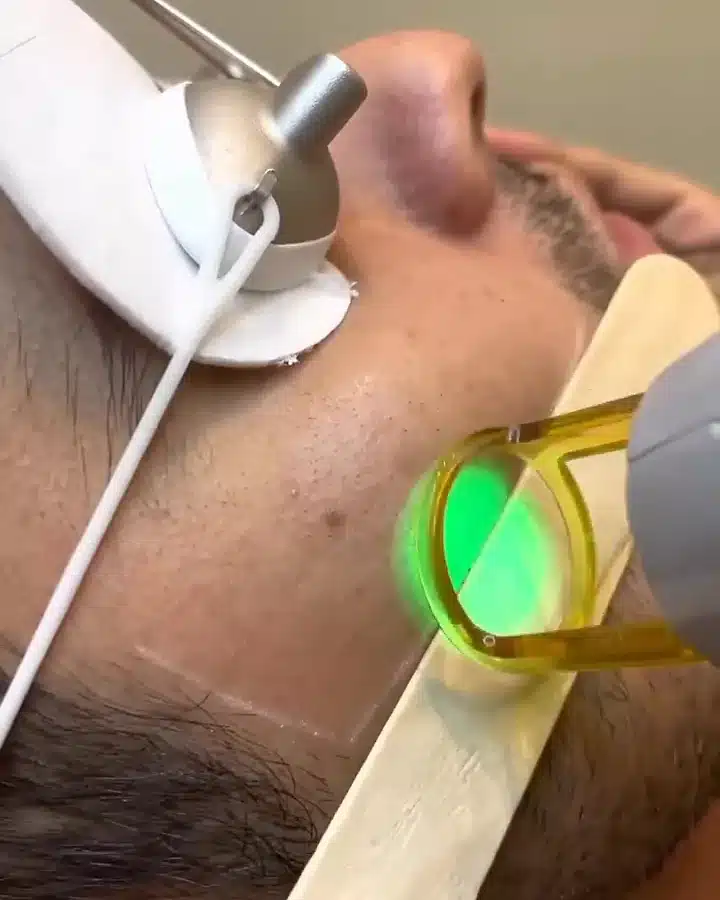 Séance d'épilation laser chez My Laser : l'embout doré de la pièce à main posé sur la joue, l'œil protégé par une coque