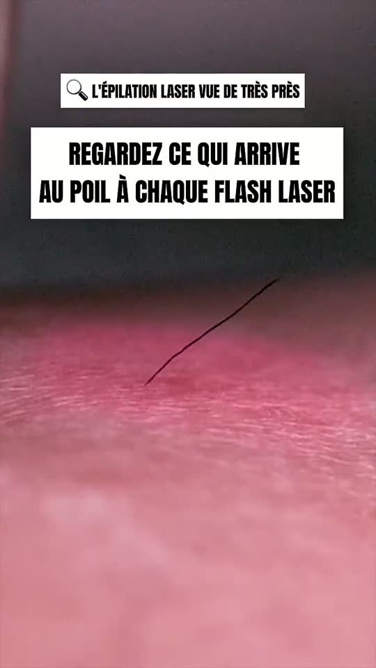 Vidéo My Laser : Le laser vu de très près : ce qui arrive au poil à chaque flash