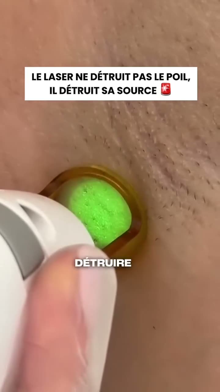 Vidéo My Laser : Comment le laser détruit le poil sans abîmer la peau